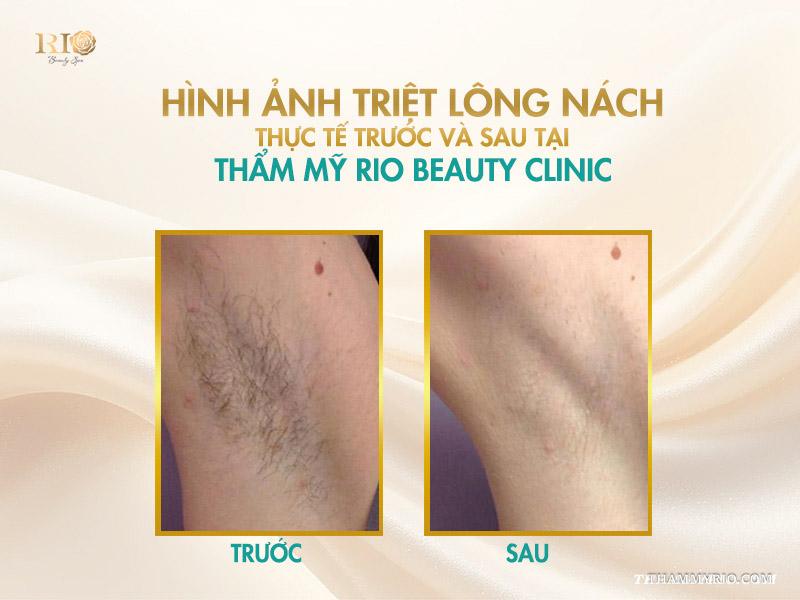 Triệt lông nách vĩnh viễn giá bao nhiêu? Cập nhật giá 2025 8 Hình ảnh triệt lông nách thực tế tại Thẩm mỹ Rio Beauty Clinic