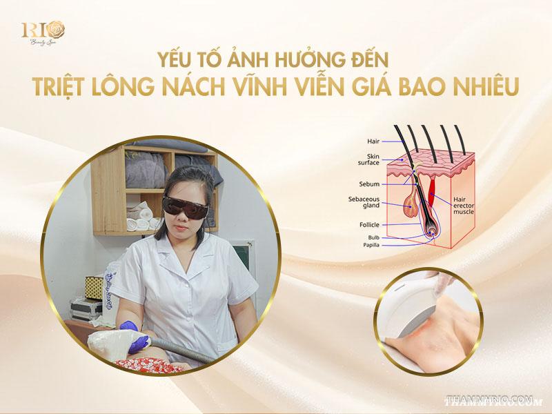 Triệt lông nách vĩnh viễn giá bao nhiêu? Cập nhật giá 2025 2 Yếu tố ảnh hưởng đến triệt lông nách vĩnh viễn giá bao nhiêu