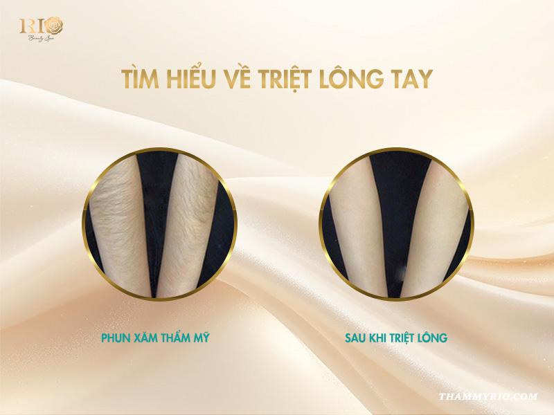 Phương pháp triệt lông tay hiệu quả 2025 bạn nên thử ngay! 3 Tìm hiểu về triệt lông tay