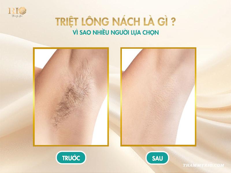 Khám phá lợi ích bất ngờ từ triệt nách có thể bạn chưa biết! 2 Triệt lông nách là gì? Vì sao nhiều người lựa chọn