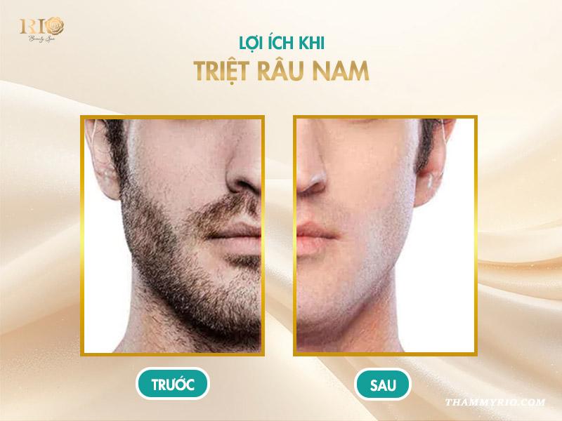 Có nên triệt râu cho nam không? Khám phá lợi ích bất ngờ! 2 Lợi ích khi triệt râu nam