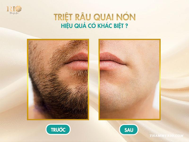 Có nên triệt râu cho nam không? Khám phá lợi ích bất ngờ! 5 Triệt râu quai nón: Hiệu quả có khác biệt?