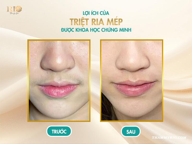 Triệt ria mép: Quy trình chuẩn y khoa tại Thẩm mỹ Rio 3 Lợi ích của triệt ria mép được khoa học chứng minh