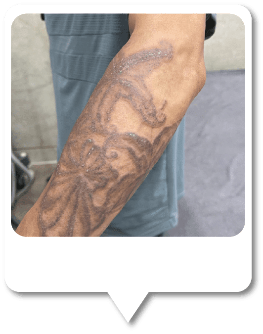 Tattoo Removal 8 6