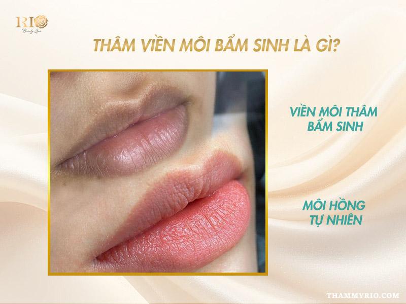 Top 5 cách trị thâm viền môi bẩm sinh dứt điểm an toàn 2 Thâm viền môi bẩm sinh do melanin và cấu trúc da môi