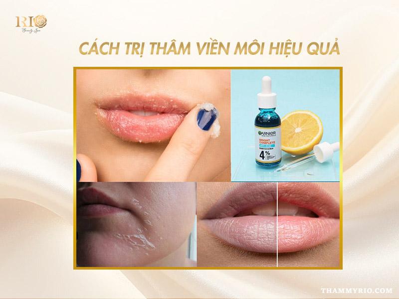 Top 5 cách trị thâm viền môi bẩm sinh dứt điểm an toàn 4 Các cách trị thâm viền môi bẩm sinh tại nhà và công nghệ cao
