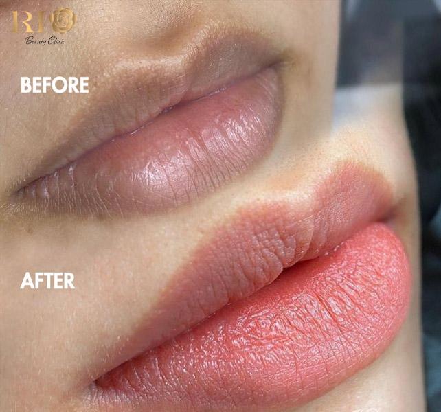 Top 5 cách trị thâm viền môi bẩm sinh dứt điểm an toàn 8 Hiệu quả xử lý thâm viền môi bẩm sinh bằng Laser công nghệ cao