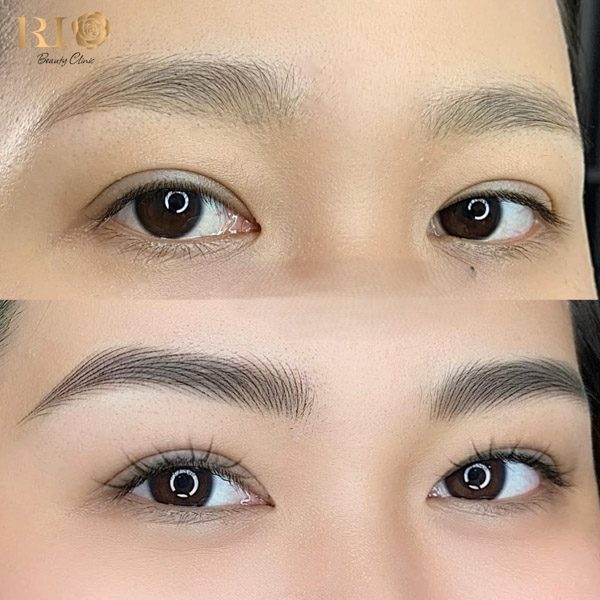 Nhược điểm của Hairstroke – hình ảnh trước và sau khi thực hiện cho thấy sự khác biệt rõ rệt về độ tự nhiên và sắc nét.