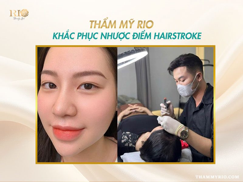 Nhược điểm của Hairstroke – được khắc phục tối ưu nhờ bàn tay chuyên gia Thẩm Mỹ Rio với kỹ thuật độc quyền.