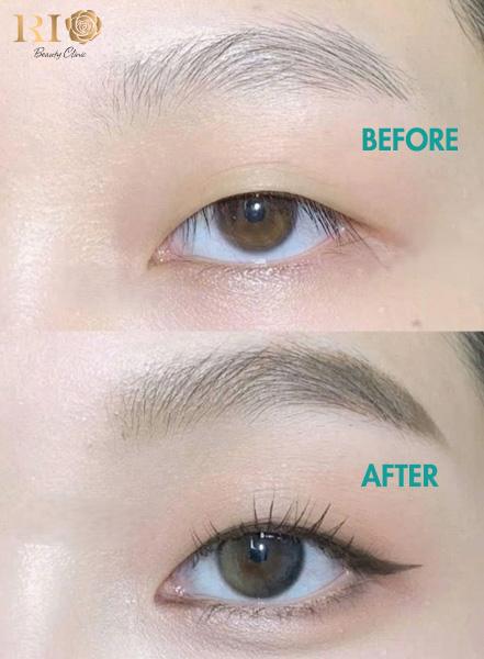 Phun mí mở tròng đá đuôi - Xu hướng cho đôi mắt cuốn hút 2026 3 Đôi mắt trước và sau khi phun mí mở tròng đá đuôi