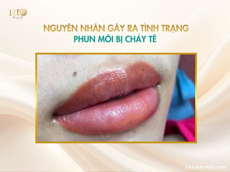 Phun môi bị cháy tê là do đâu? Cách khắc phục an toàn 3 Nguyên nhân gây ra tình trạng phun môi bị cháy tê