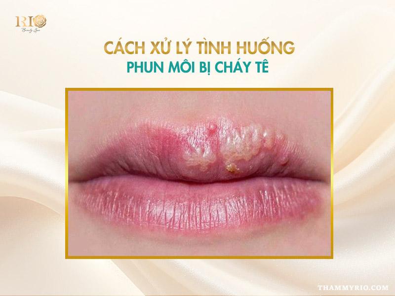 Phun môi bị cháy tê là do đâu? Cách khắc phục an toàn 4 Cách xử lý tình huống phun môi bị cháy tê