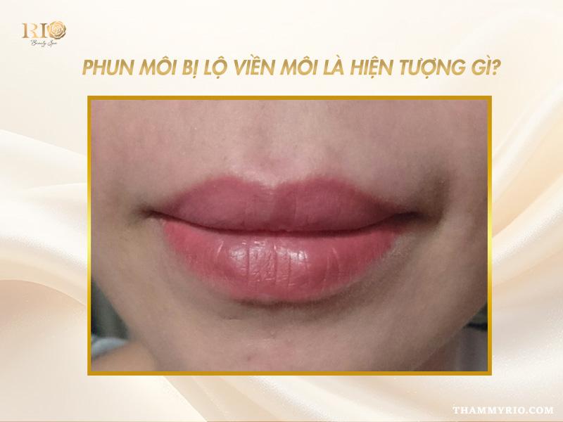 Phun môi bị lộ viền môi xử lý thế nào chuẩn, ít tốn kém? 2 Phun môi bị lộ viền môi là hiện tượng gì? Dấu hiệu nhận biết và nguyên nhân phổ biến khiến màu môi không đều viền.