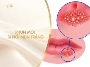 Phun môi bị nổi mụn trắng