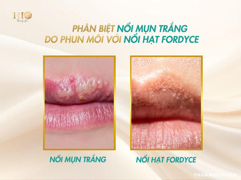 Sau khi phun môi bị nổi mụn trắng là do đâu? Cách xử lý 2 Phân biệt phun môi bị nổi mụn trắng và hạt Fordyce