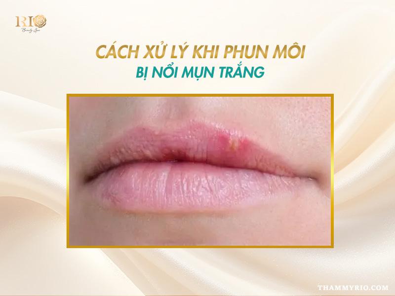 Sau khi phun môi bị nổi mụn trắng là do đâu? Cách xử lý 4 Cách xử lý khi phun môi bị nổi mụn trắng