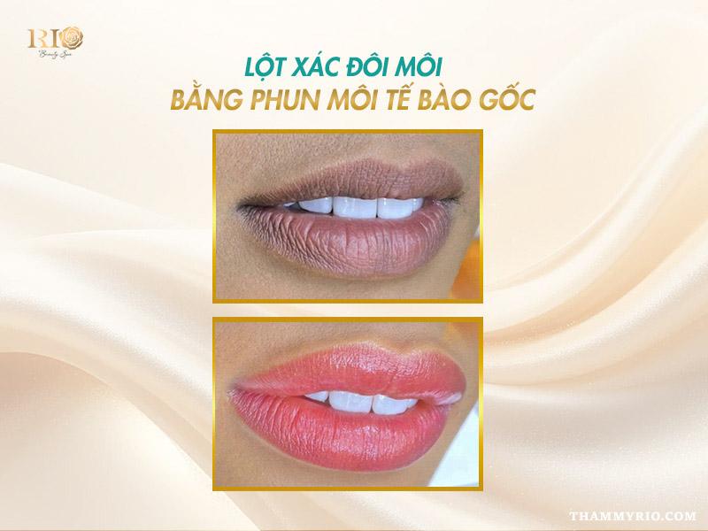 Phun môi tế bào gốc là gì? Lợi ích và giá dịch vụ mới nhất 2 Phun môi tế bào gốc giúp đôi môi khô trở nên căng mọng, hồng hào tự nhiên.