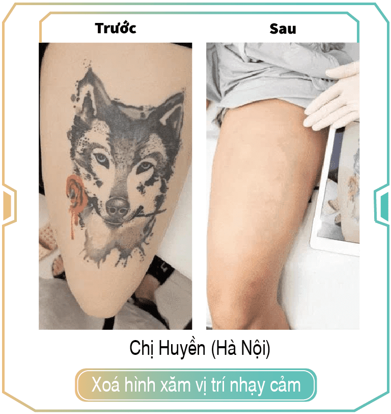 Tattoo Removal 41 Truoc sau 01
