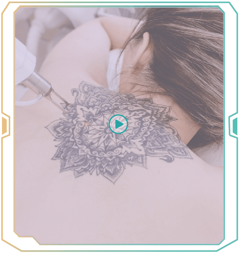 Tattoo Removal 42 Untitled 4 01