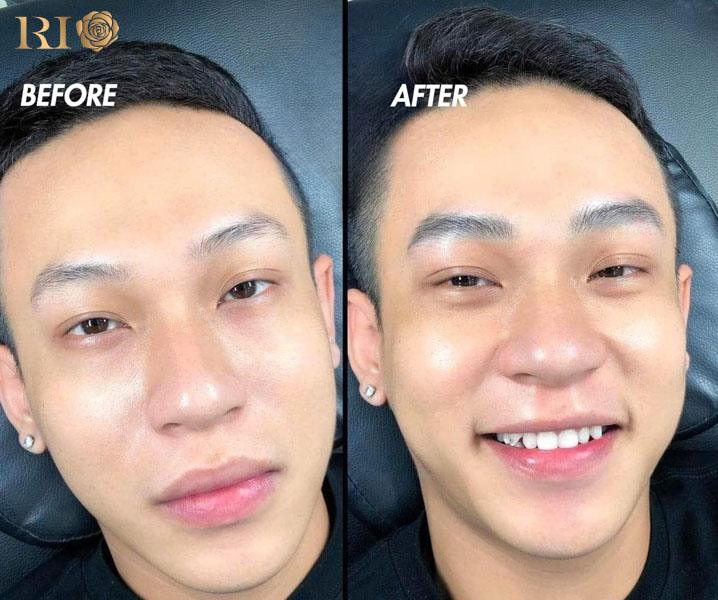 Before-after phun xăm chân mày nam kết hợp: Kết quả tự nhiên tăng sự tự tin cho doanh nhân trẻ