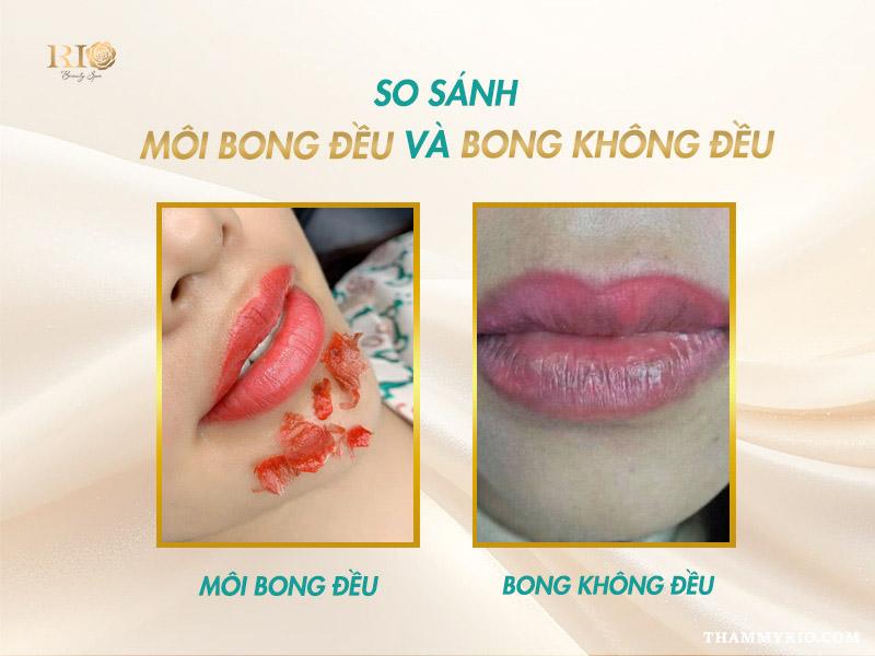 Xăm môi bị bầm tím có sao không? Cách xử lý hiệu quả tại nhà 5 Môi bong đều và không đều sau phun tại Thẩm Mỹ Rio