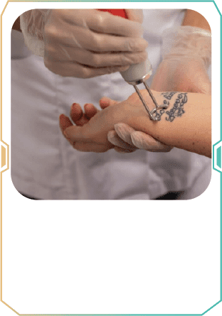 Tattoo Removal 39 b3
