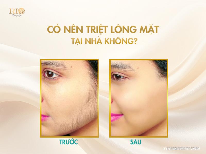 7 cách triệt lông mặt vĩnh viễn tại nhà hiệu quả nhất 2 Có nên triệt lông mặt tại nhà không?