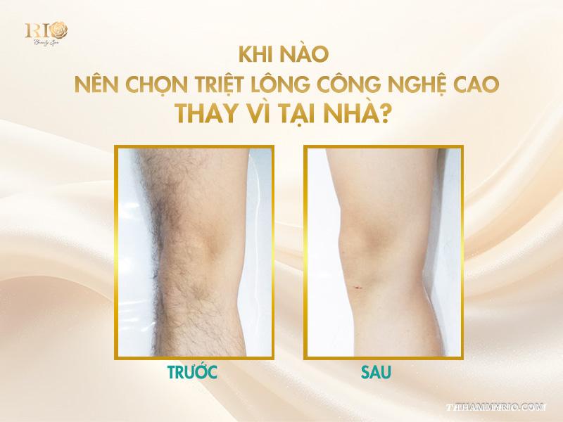 Lưu ý quan trọng khi áp dụng cách triệt lông tại nhà 5 Khi nào nên chọn triệt lông công nghệ cao thay vì tại nhà?