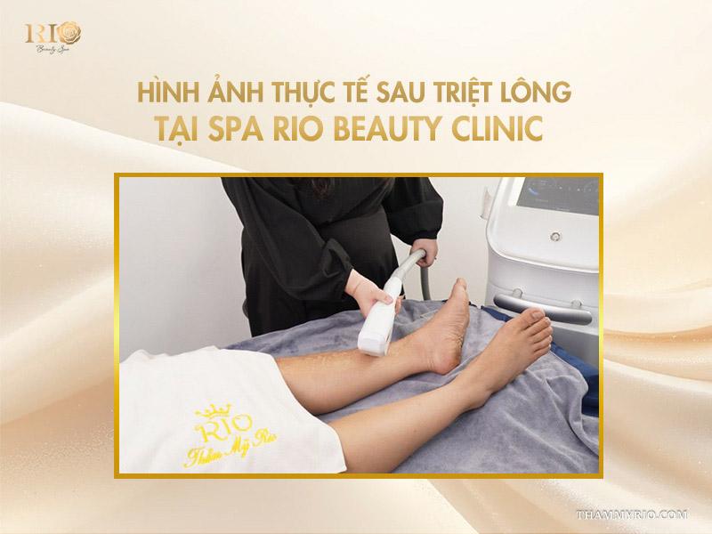 Lưu ý quan trọng khi áp dụng cách triệt lông tại nhà 7 Hình ảnh thực tế khi triệt lông tại spa Rio Beauty Clinic