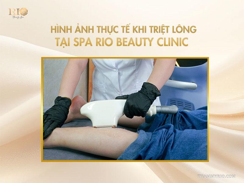 Lưu ý quan trọng khi áp dụng cách triệt lông tại nhà 8 Hình ảnh thực tế khi triệt lông tại spa Rio Beauty Clinic