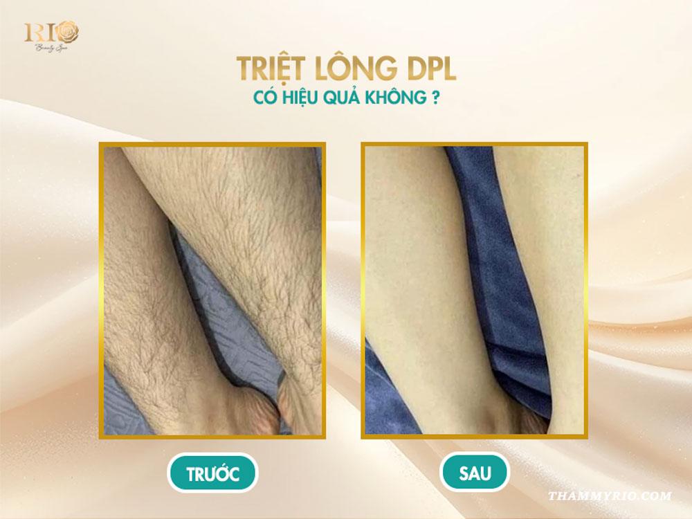 Công nghệ triệt lông DPL: 5 ưu điểm và hiệu quả thực tế 8 Triệt lông DPL có hiệu quả không?