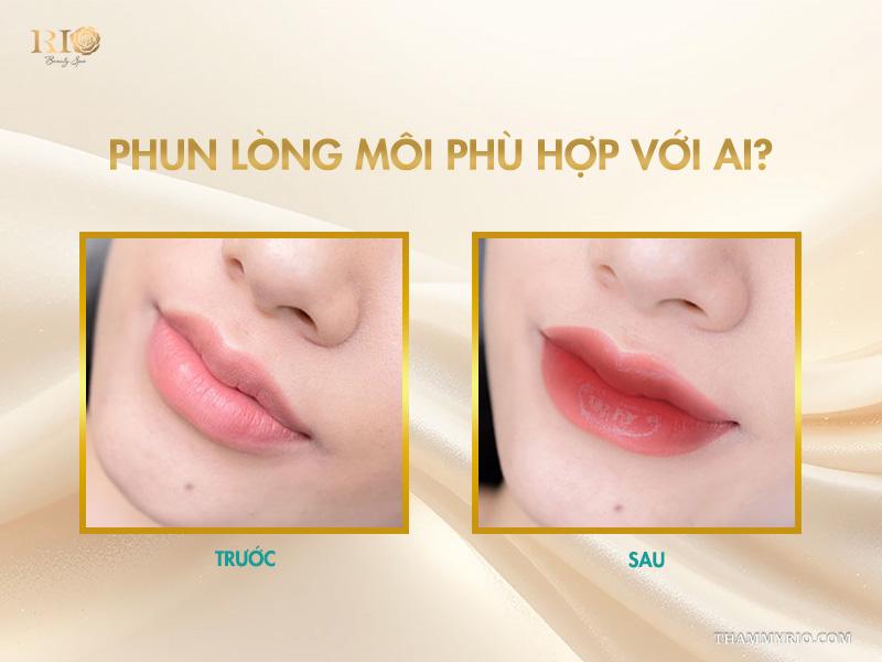 Phun lòng môi – Bí quyết cho đôi môi căng mọng, tự nhiên 3 Phun lòng môi phù hợp với ai?