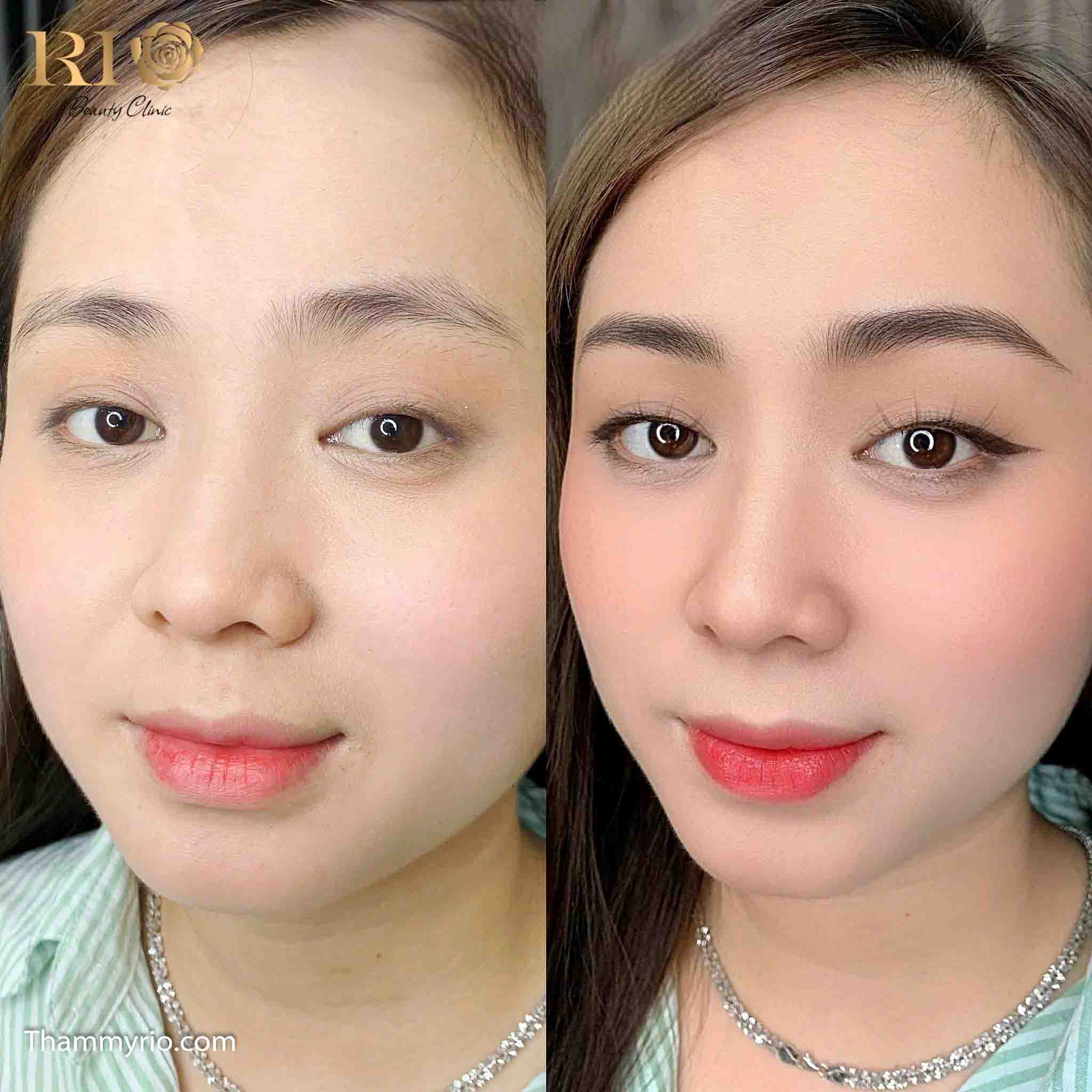 Eyelid spraying 31 phun mi mat 26