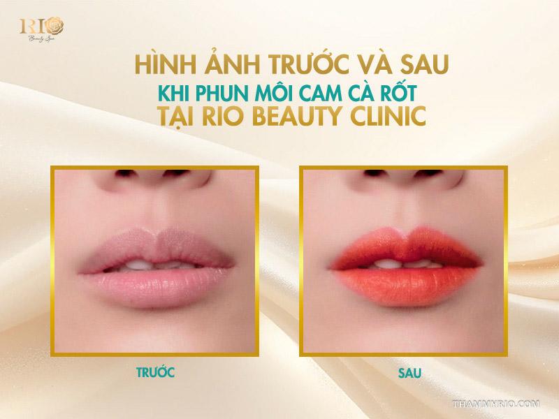 Phun môi màu cam cà rốt – tone cam hot giúp đôi môi rạng rỡ 10 Hình ảnh trước và sau khi phun môi cam cà rốt tại Rio Beauty Clinic
