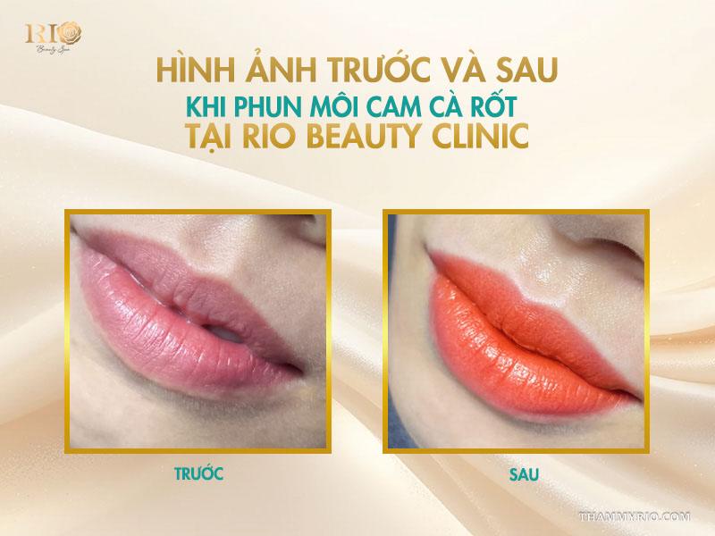 Phun môi màu cam cà rốt – tone cam hot giúp đôi môi rạng rỡ 6 Hình ảnh trước và sau khi phun môi cam cà rốt tại Rio Beauty Clinic