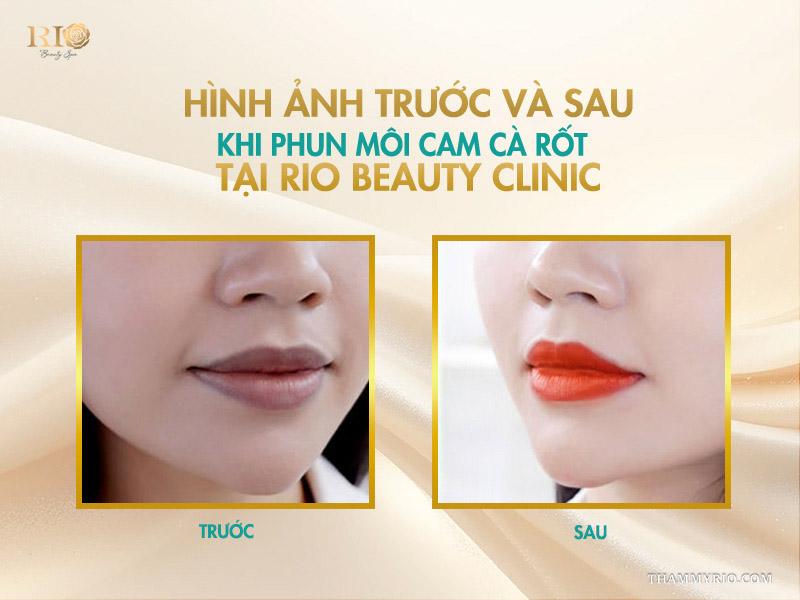Phun môi màu cam cà rốt – tone cam hot giúp đôi môi rạng rỡ 8 Hình ảnh trước và sau khi phun môi cam cà rốt tại Rio Beauty Clinic