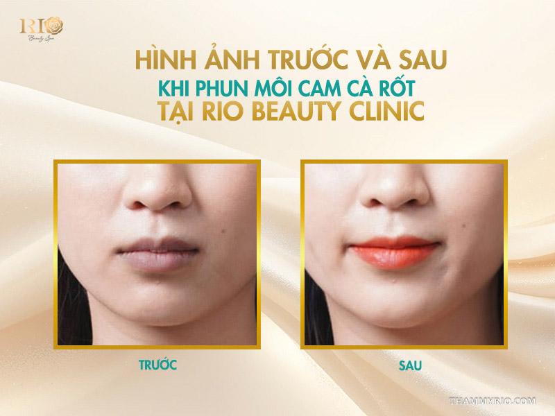 Phun môi màu cam cà rốt – tone cam hot giúp đôi môi rạng rỡ 9 Hình ảnh trước và sau khi phun môi cam cà rốt tại Rio Beauty Clinic