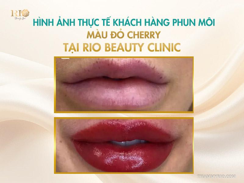 Phun môi màu đỏ cherry: Tông màu “nịnh da” được ưa chuộng nhất 4 Hình ảnh thực tế khách hàng phun môi màu đỏ cherry tại Rio Beauty Clinic