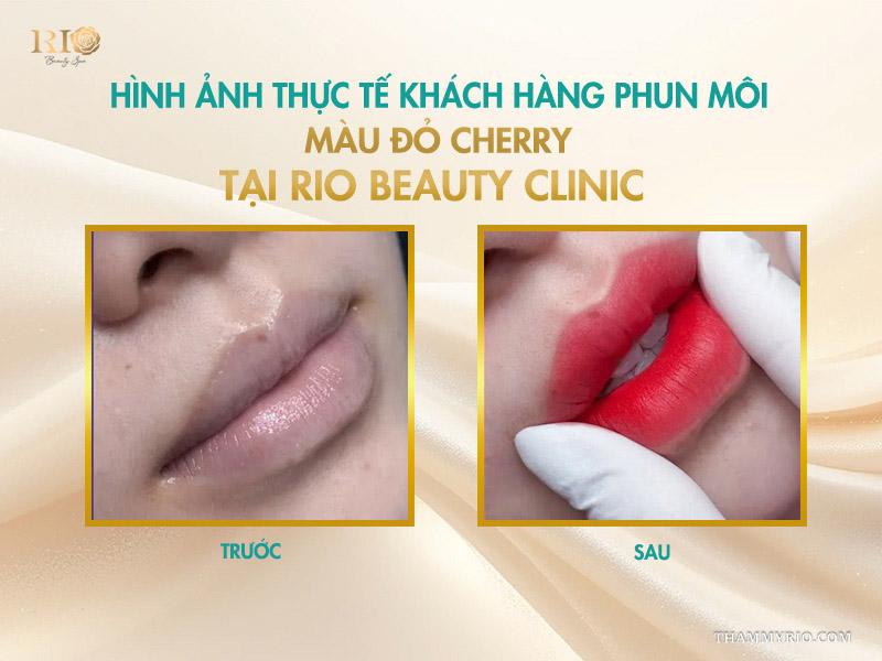 Phun môi màu đỏ cherry: Tông màu “nịnh da” được ưa chuộng nhất 5 Hình ảnh thực tế khách hàng phun môi màu đỏ cherry tại Rio Beauty Clinic