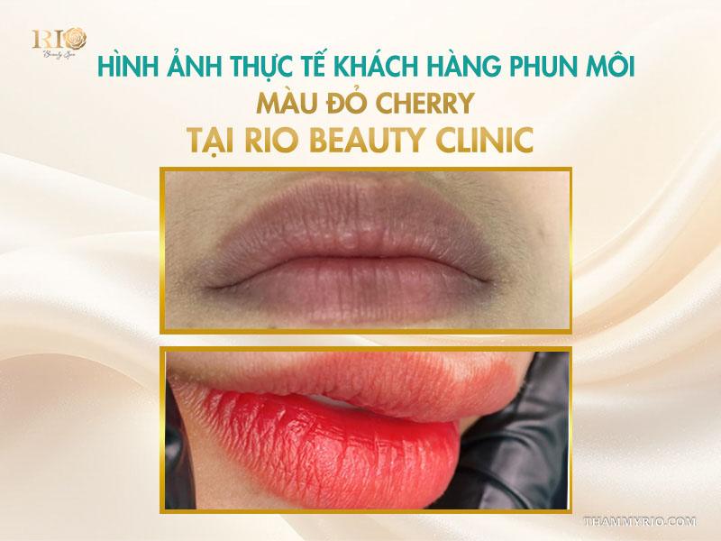 Phun môi màu đỏ cherry: Tông màu “nịnh da” được ưa chuộng nhất 9 Hình ảnh thực tế khách hàng phun môi màu đỏ cherry tại Rio Beauty Clinic