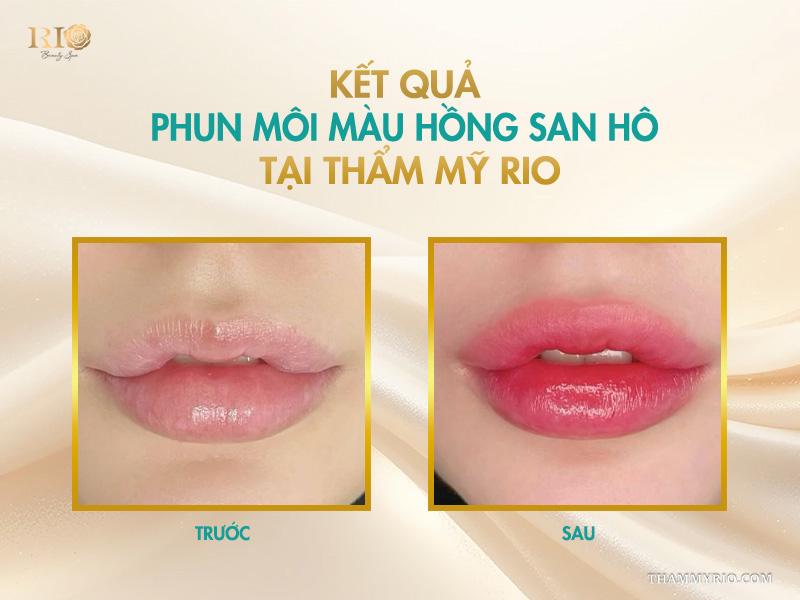 Phun môi màu hồng san hô - Cập nhật bảng giá mới nhất 2026 6 Kết quả sau phun môi màu hồng san hô tại Thẩm Mỹ Rio – môi căng bóng, tươi tắn tự nhiên.