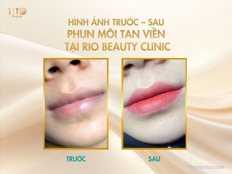 Phun môi tan viền -  Giải mã “cơn sốt” vạn người mê! 11 Hình ảnh trước – sau phun môi tan viền tại Rio Beauty Clinic