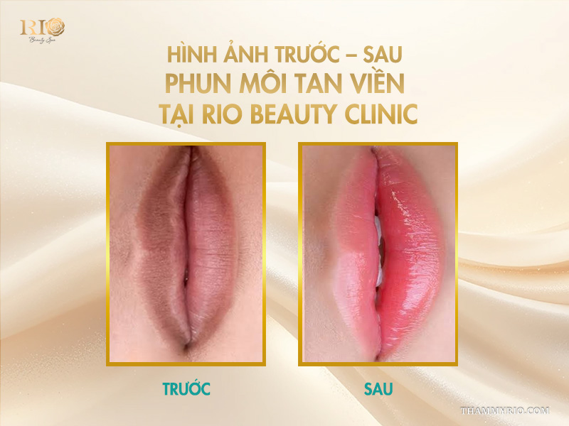 Phun môi tan viền -  Giải mã “cơn sốt” vạn người mê! 7 Hình ảnh trước – sau phun môi tan viền tại Rio Beauty Clinic