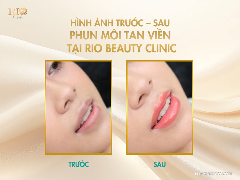Phun môi tan viền -  Giải mã “cơn sốt” vạn người mê! 10 Hình ảnh trước – sau phun môi tan viền tại Rio Beauty Clinic