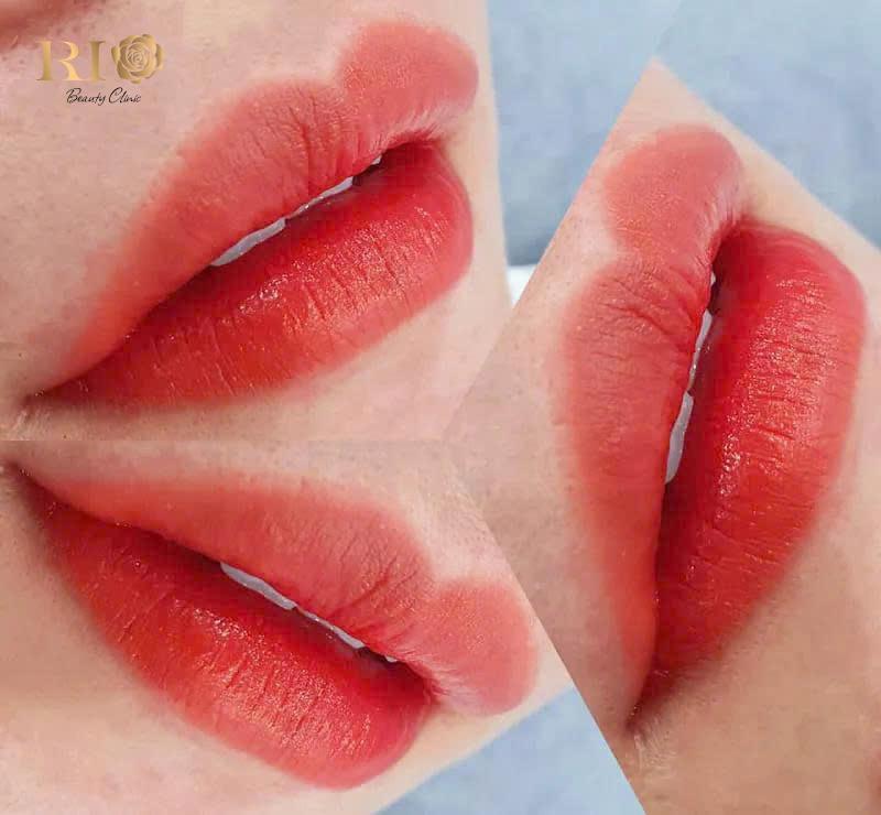 Phun môi tế bào gốc là gì? Lợi ích và giá dịch vụ mới nhất 6 Phun môi tế bào gốc phục hồi môi thâm xỉn, giúp màu sắc tươi sáng tự nhiên.