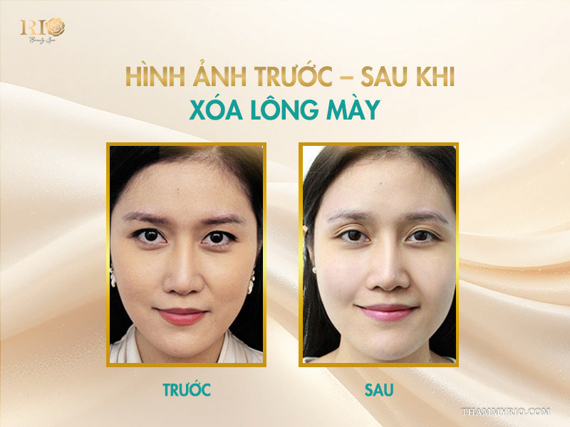 Xóa xăm lông mày an toàn tại spa phun xăm Thẩm Mỹ Rio không để lại sẹo