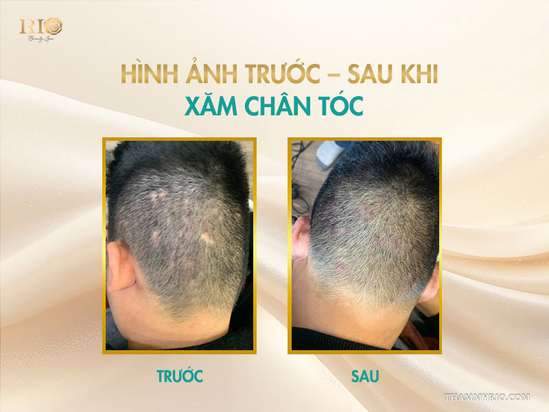 Xăm chân tóc che khuyết điểm vùng trán và đỉnh đầu tại spa phun xăm Thẩm Mỹ Rio