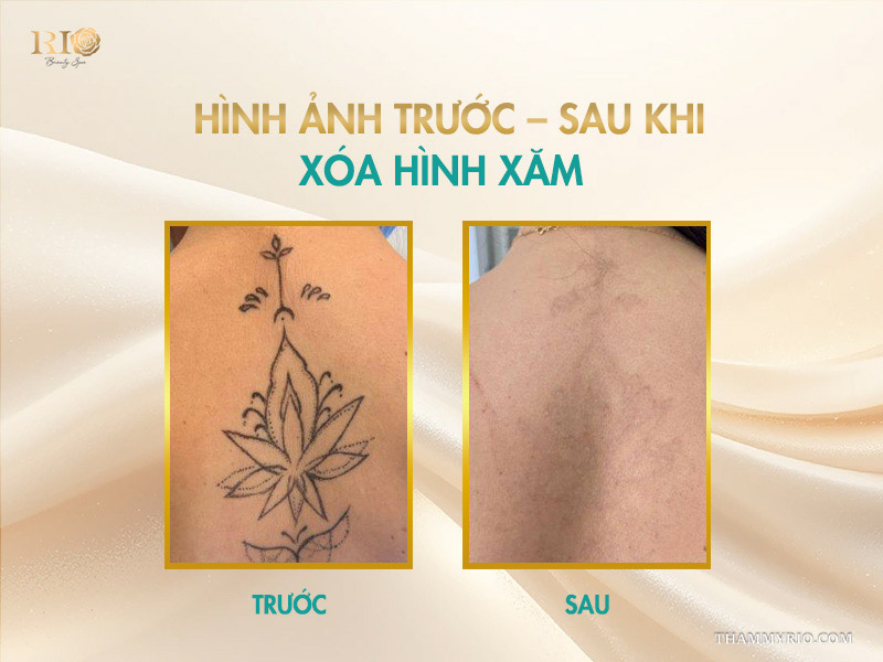 Dịch vụ xóa hình xăm bằng công nghệ laser hiện đại tại spa phun xăm Thẩm Mỹ Rio