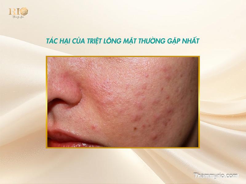 Tác hại của triệt lông mặt thường gặp nhất
