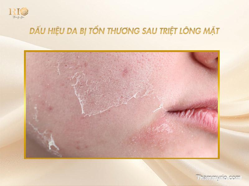 Dấu hiệu da bị tổn thương sau triệt lông mặt